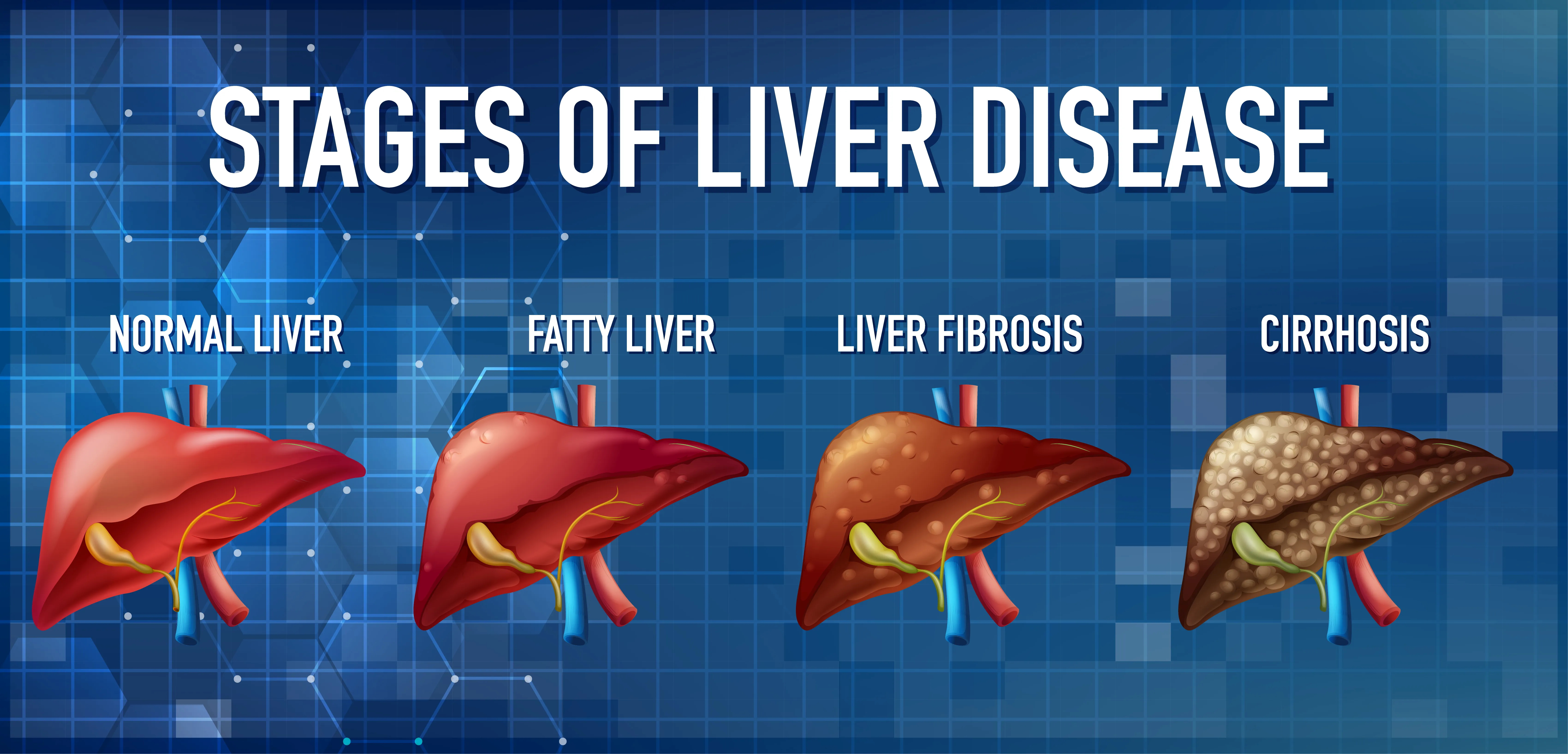 Liver Health Matters Understanding Hepatitis and Liver Disease