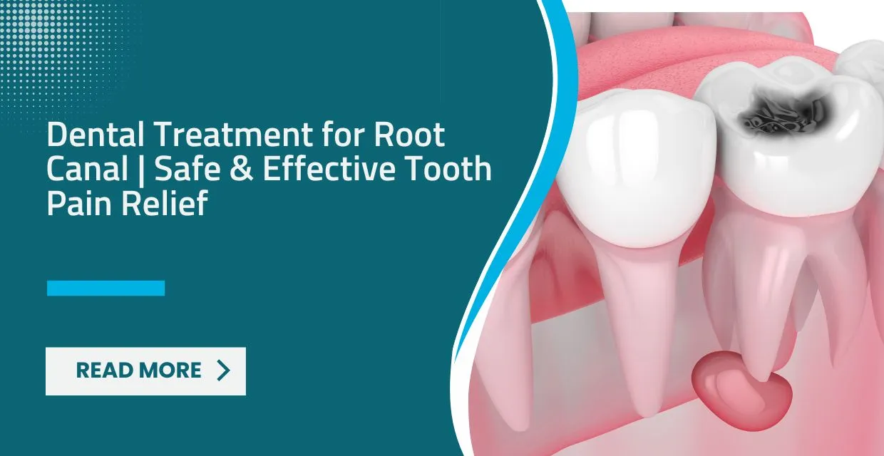 Dental Treatment for Root Canal: Saving Your Smile