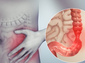 IBS-irritable-bowel-syndrome
